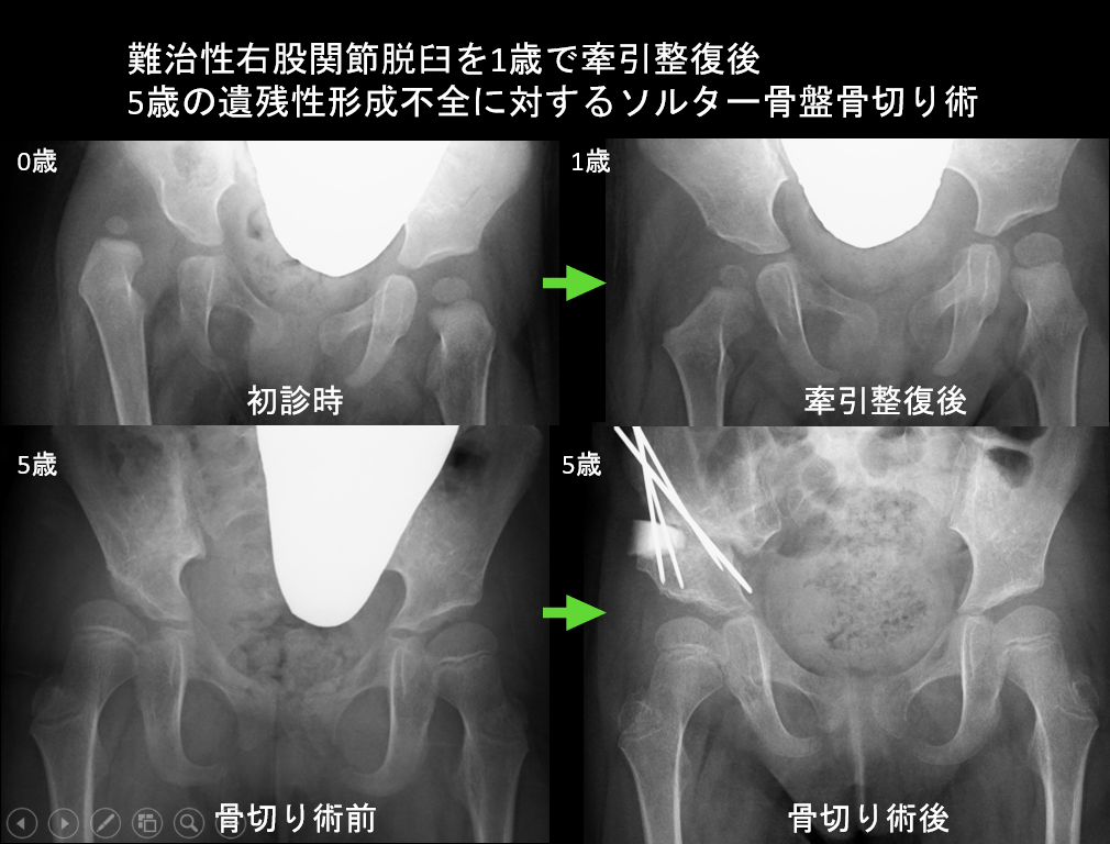 乳児股関節脱臼 福井県ホームページ