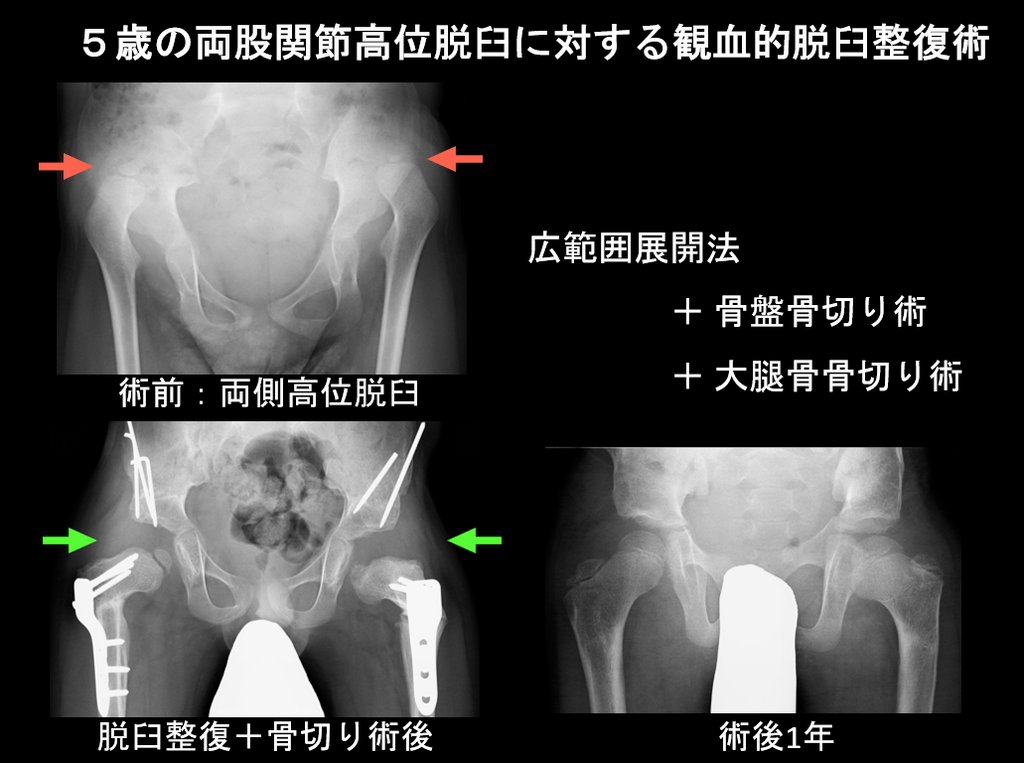 先天性股関節脱臼の原因は何ですか?