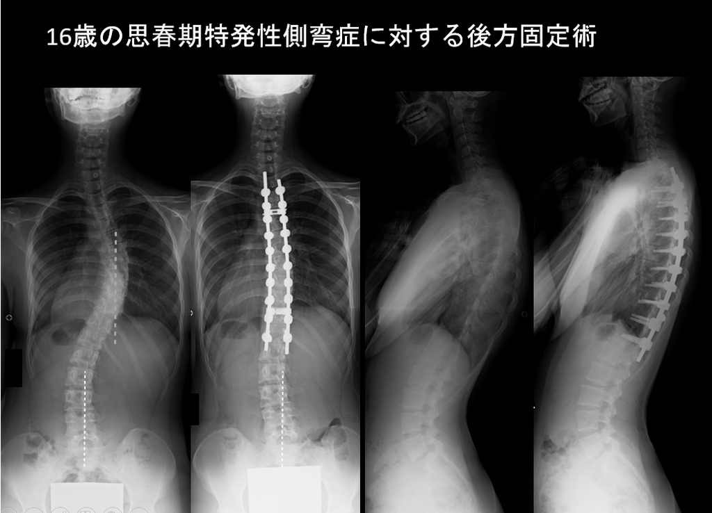 脊柱側弯症 福井県ホームページ